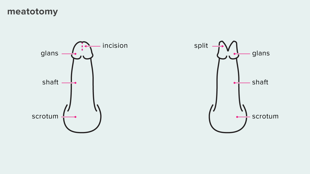 Masturbation by inserting inot penis