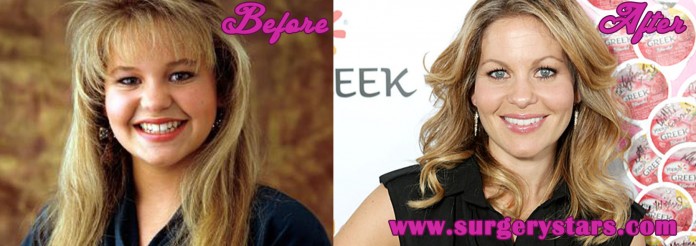 Candacecameron plastic surgery before and pictures